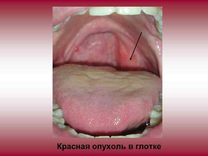 Красная опухоль в глотке 
