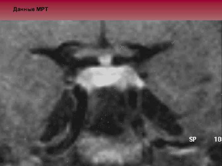 Данные МРТ 