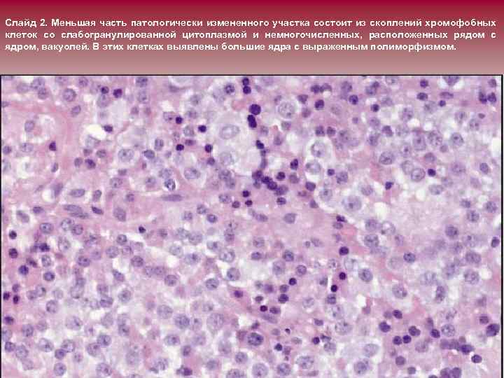 Слайд 2. Меньшая часть патологически измененного участка состоит из скоплений хромофобных клеток со слабогранулированной