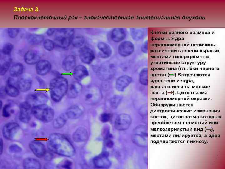 Задача 3. Плоскоклеточный рак – злокачественная эпителиальная опухоль. Клетки разного размера и формы. Ядра