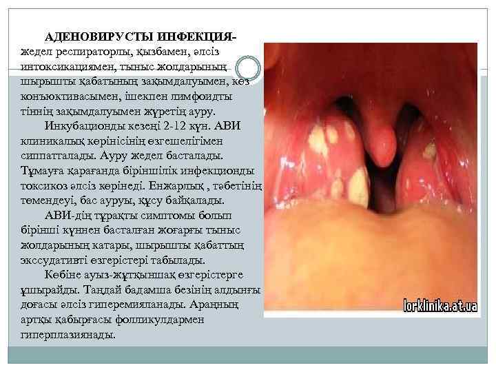 АДЕНОВИРУСТЫ ИНФЕКЦИЯжедел респираторлы, қызбамен, әлсіз интоксикациямен, тыныс жолдарының шырышты қабатының зақымдалуымен, көз конъюктивасымен, ішекпен