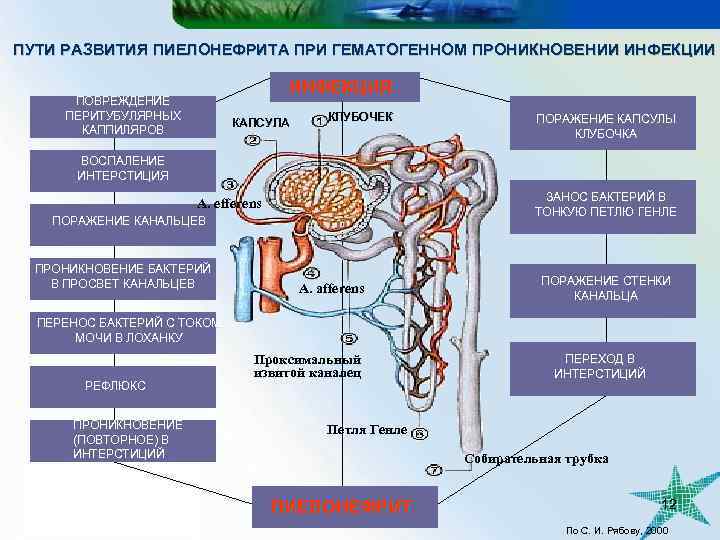 ПУТИ РАЗВИТИЯ ПИЕЛОНЕФРИТА ПРИ ГЕМАТОГЕННОМ ПРОНИКНОВЕНИИ ИНФЕКЦИЯ ПОВРЕЖДЕНИЕ ПЕРИТУБУЛЯРНЫХ КАППИЛЯРОВ КАПСУЛА КЛУБОЧЕК ПОРАЖЕНИЕ КАПСУЛЫ
