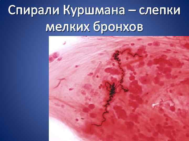 Спирали Куршмана – слепки мелких бронхов 