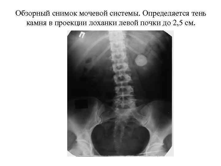 Обзорный снимок. Обзорная рентгенография органов мочевой системы. Обзорная урография камни в почках. Обзорный снимок рентген почки.