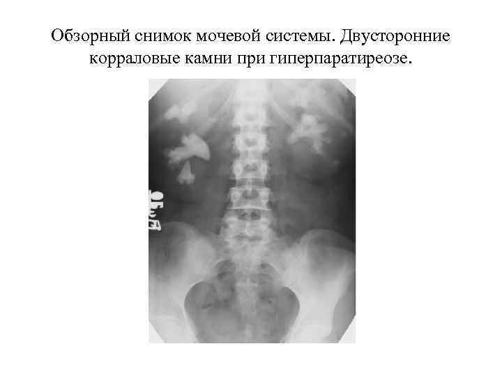 Обзорный снимок мочевой системы. Двусторонние корраловые камни при гиперпаратиреозе. 