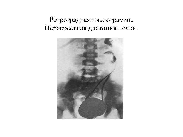 Ретроградная пиелограмма. Перекрестная дистопия почки. 