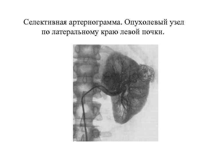  Селективная артериограмма. Опухолевый узел по латеральному краю левой почки. 