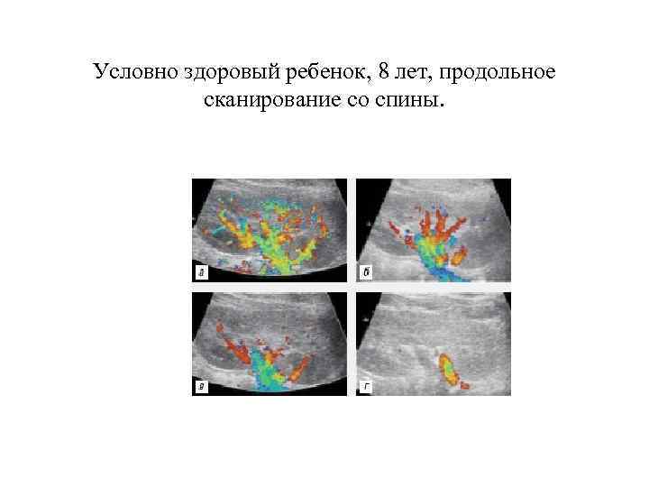 Условно здоровый ребенок, 8 лет, продольное сканирование со спины. 