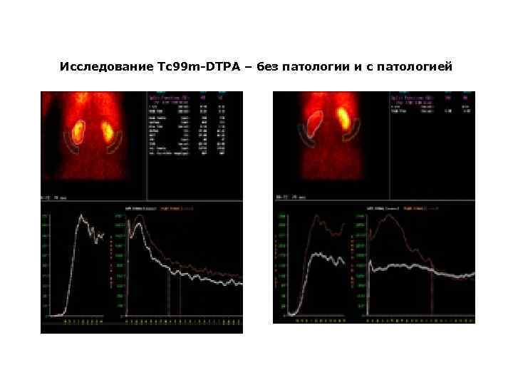 Исследование Tc 99 m-DTPA – без патологии и с патологией 