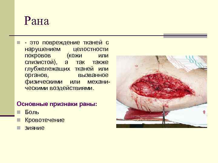 Рана n - это повреждение тканей с нарушением целостности покровов (кожи или слизистой), а