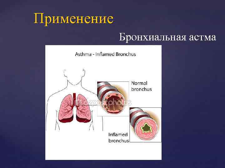 Применение Бронхиальная астма 