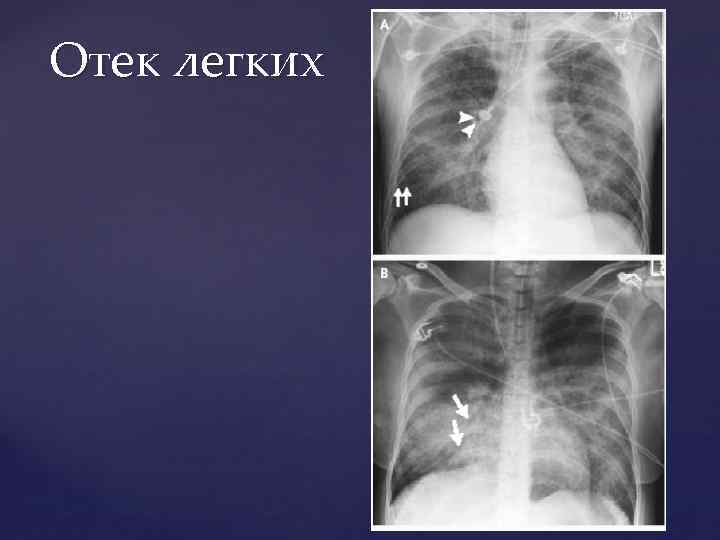 Отек легких 