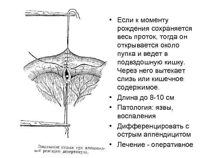  • Если к моменту рождения сохраняется весь проток, тогда он открывается около пупка