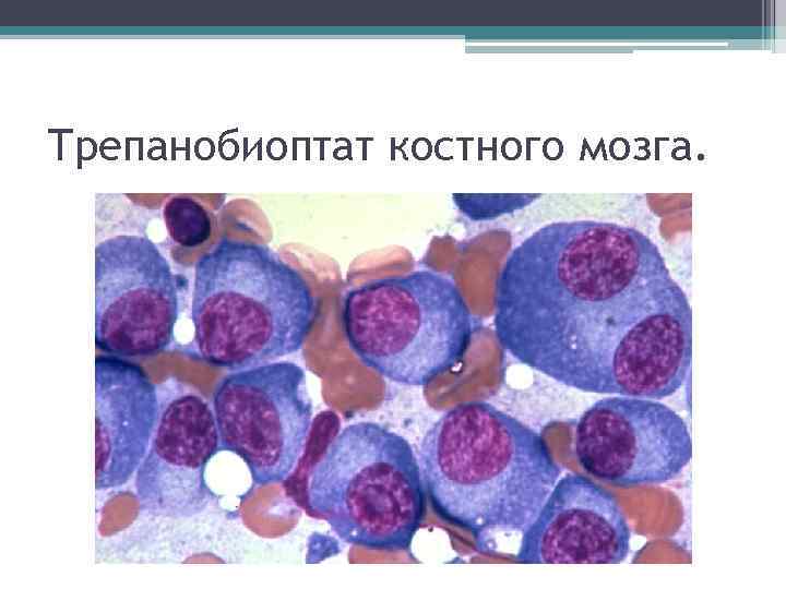 Трепанобиоптат костного мозга. 