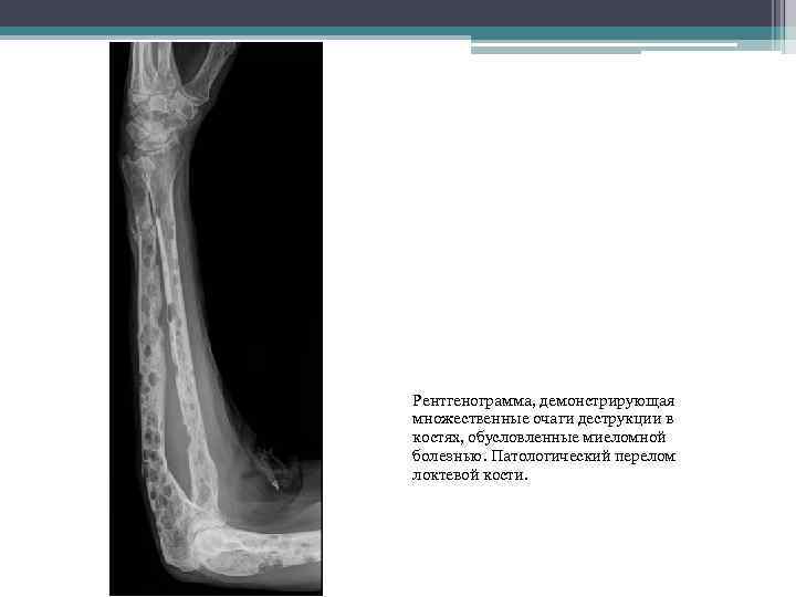Рентгенограмма, демонстрирующая множественные очаги деструкции в костях, обусловленные миеломной болезнью. Патологический перелом локтевой кости.