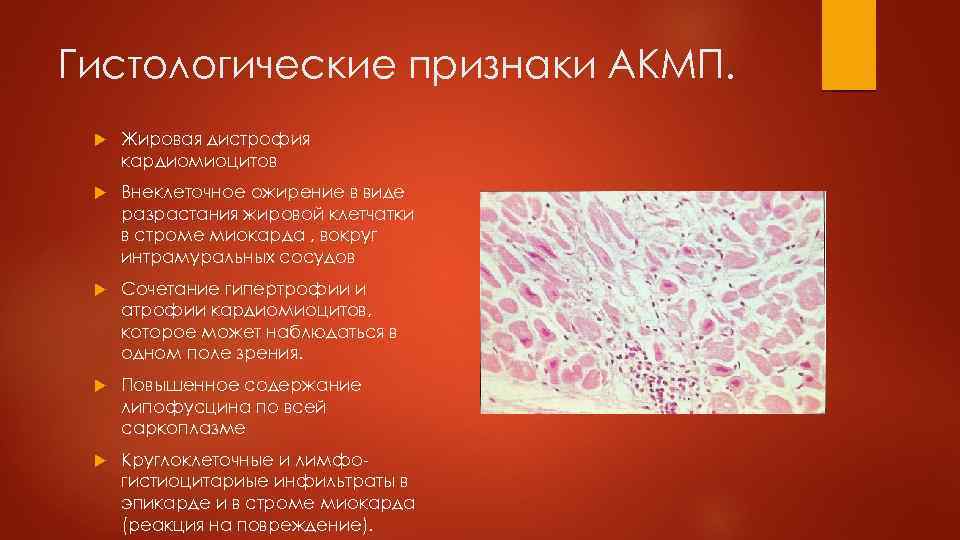 Гистологические признаки АКМП. Жировая дистрофия кардиомиоцитов Внеклеточное ожирение в виде разрастания жировой клетчатки в