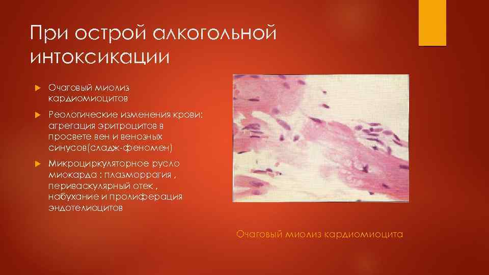 При острой алкогольной интоксикации Очаговый миолиз кардиомиоцитов Реологические изменения крови: агрегация эритроцитов в просвете