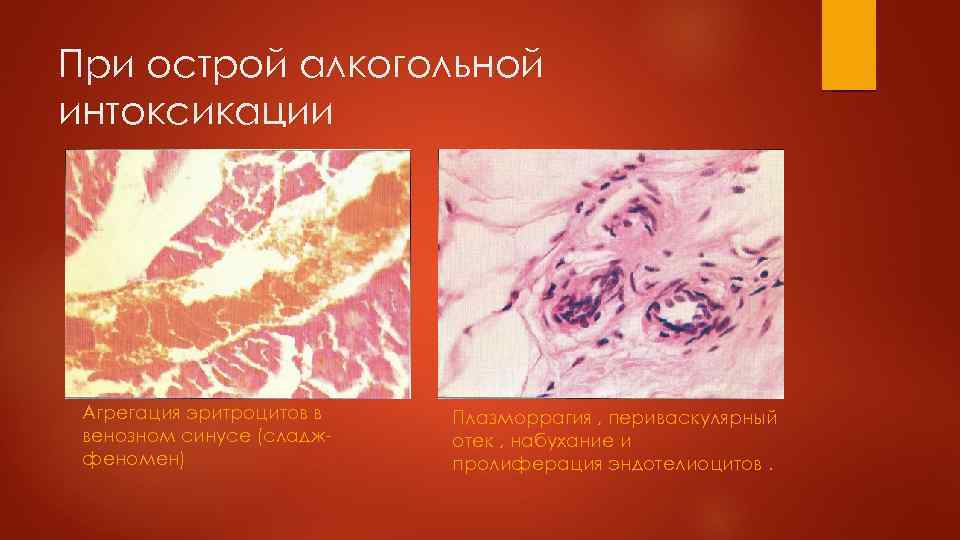 При острой алкогольной интоксикации Агрегация эритроцитов в венозном синусе (сладжфеномен) Плазморрагия , периваскулярный отек