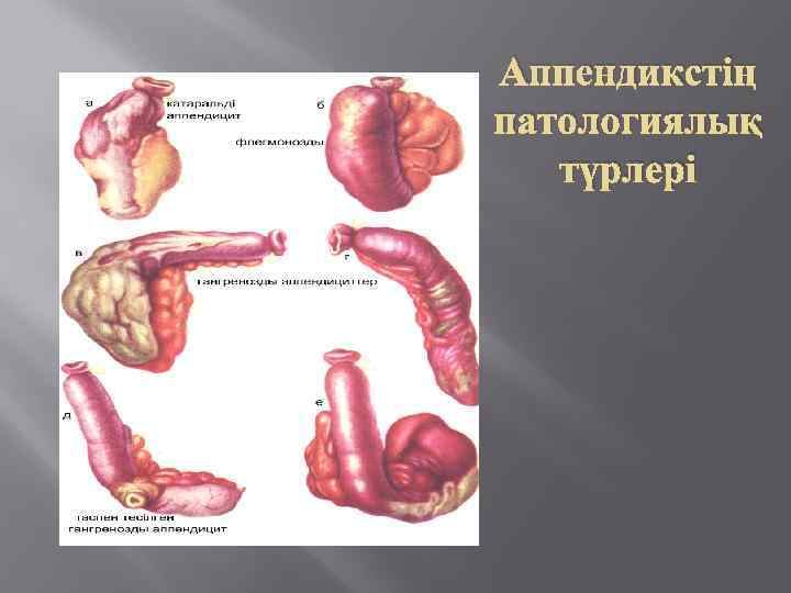Аппендикстің патологиялық түрлері 