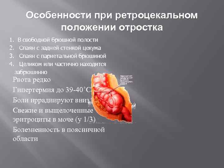 Особенности при ретроцекальном положении отростка 1. 2. 3. 4. В свободной брюшной полости Спаян