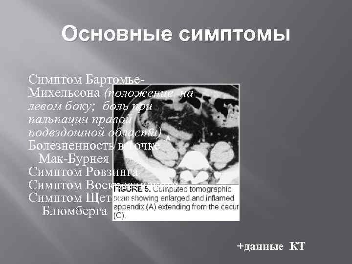 Основные симптомы Симптом Бартомье. Михельсона (положение на левом боку; боль при пальпации правой подвздошной