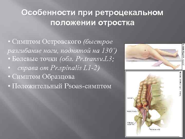 Особенности при ретроцекальном положении отростка • Симптом Островского (быстрое разгибание ноги, поднятой на 130˚)
