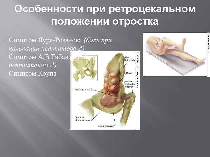 Особенности при ретроцекальном положении отростка Симптом Яуре-Розанова (боль при пальпации петтитова Δ) Симптом А.