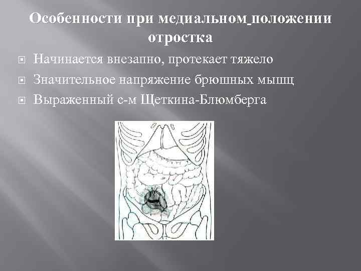 Особенности при медиальном положении отростка Начинается внезапно, протекает тяжело Значительное напряжение брюшных мышц Выраженный