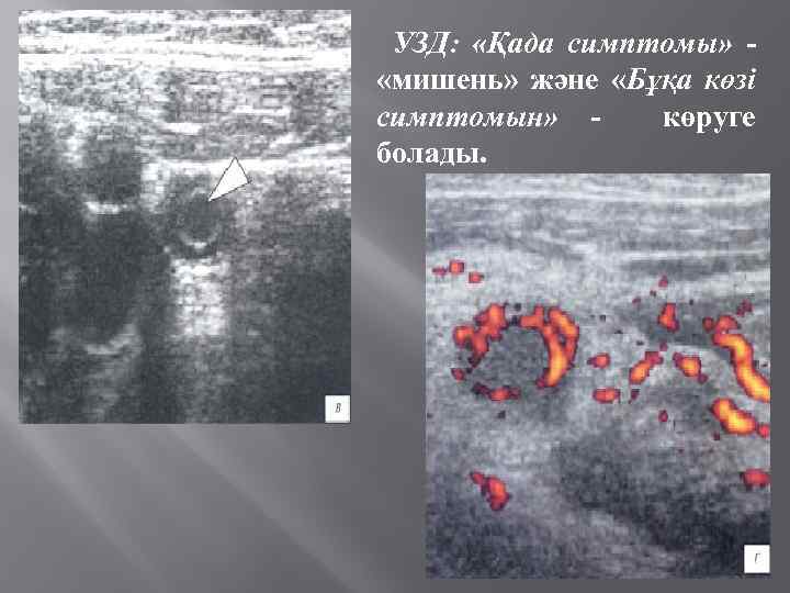 УЗД: «Қада симптомы» «мишень» және «Бұқа көзі симптомын» көруге болады. 