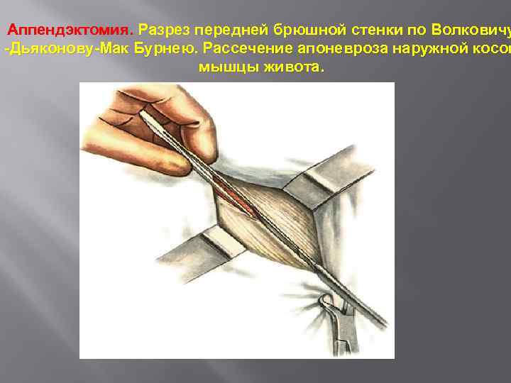 Аппендэктомия. Разрез передней брюшной стенки по Волковичу -Дьяконову-Мак Бурнею. Рассечение апоневроза наружной косой мышцы
