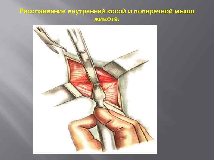 Расслаивание внутренней косой и поперечной мышц живота. 