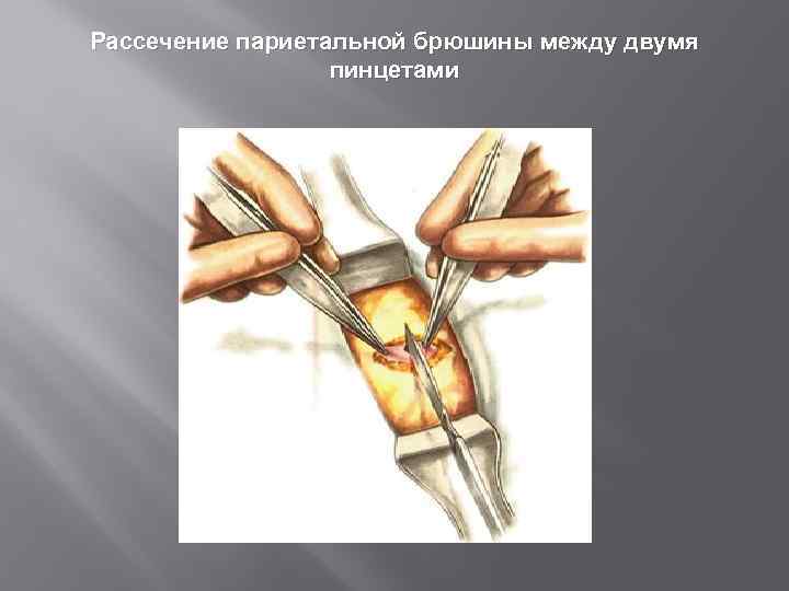 Рассечение париетальной брюшины между двумя пинцетами 