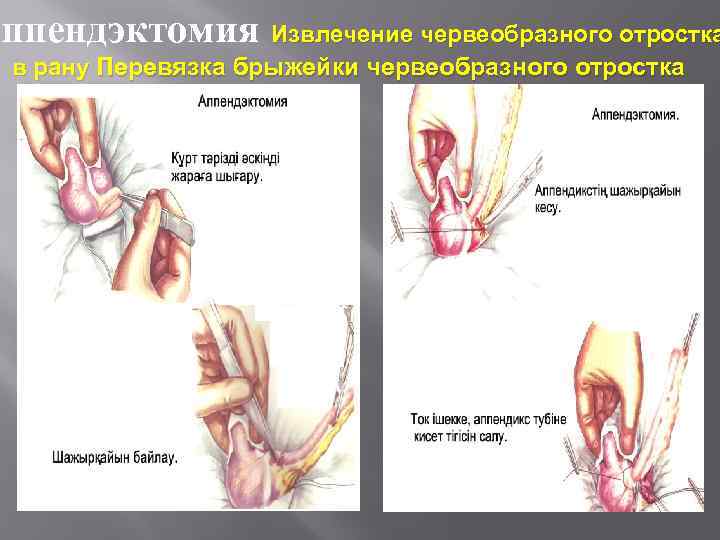 Аппендэктомия Извлечение червеобразного отростка в рану Перевязка брыжейки червеобразного отростка 