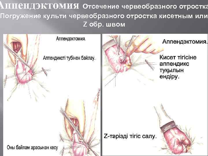 Аппендэктомия Отсечение червеобразного отростка Погружение культи червеобразного отростка кисетным или Z обр. швом 