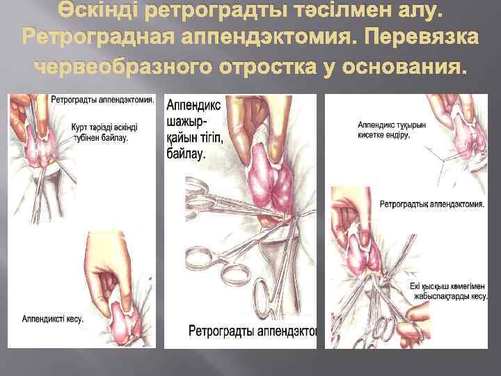 Өскінді ретроградты тәсілмен алу. Ретроградная аппендэктомия. Перевязка червеобразного отростка у основания. 