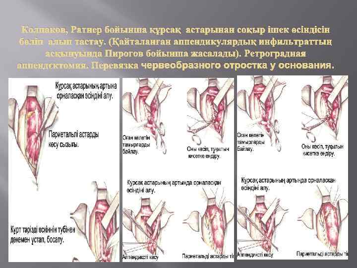 Колпаков, Ратнер бойынша құрсақ астарынан соқыр ішек өсіндісін бөліп алып тастау. (Қайталанған аппендикулярдық инфильтраттың