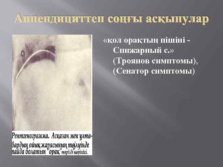 Аппендициттен соңғы асқынулар «қол орақтың пiшiнi Спижарный с. » (Троянов симптомы), (Сенатор симптомы) 