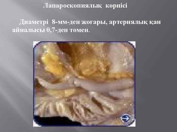 Лапароскопиялық көрнісі Диаметрі 8 -мм-ден жоғары, артериялық қан айналысы 0, 7 -ден төмен. 