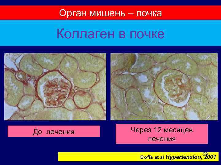 Орган мишень – почка Коллаген в почке До лечения Через 12 месяцев лечения 29