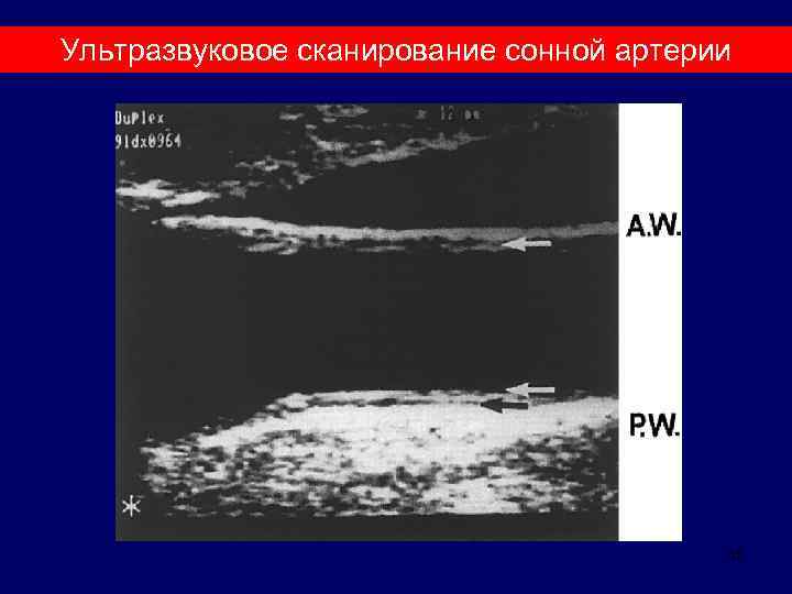 Ультразвуковое сканирование сонной артерии 35 