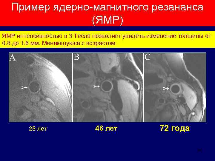 Пример ядерно-магнитного резананса (ЯМР) ЯМР интенсивностью в 3 Тесла позволяет увидеть изменение толщины от