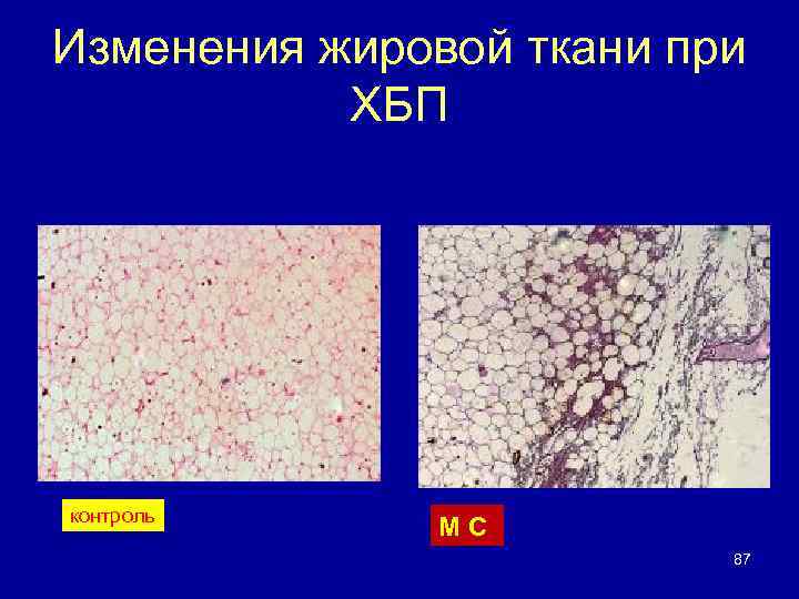 Изменения жировой ткани при ХБП контроль М С 87 