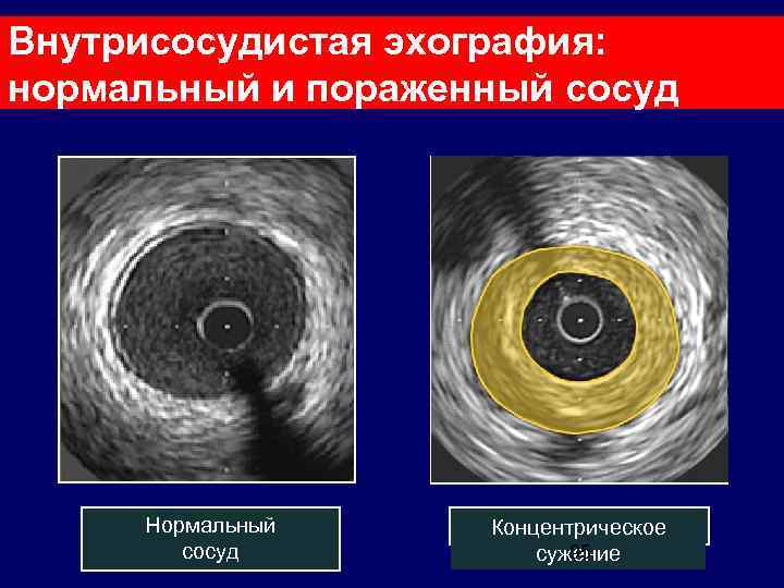 Внутрисосудистая эхография: нормальный и пораженный сосуд Aventitia EEM Border Media Intima Lumen Catheter Guide