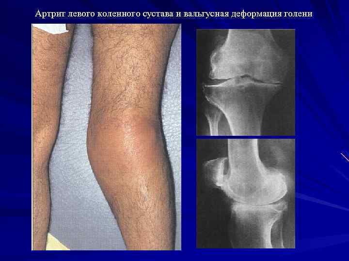 Артрит левого коленного сустава и вальгусная деформация голени 