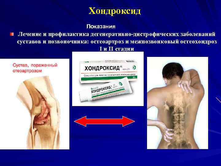 Хондроксид Показания Лечение и профилактика дегенеративно-дистрофических заболеваний суставов и позвоночника: остеоартроз и межпозвонковый остеохондроз