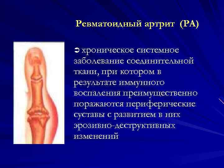 Ревматоидный артрит (РА) Ü хроническое системное заболевание соединительной ткани, при котором в результате иммунного