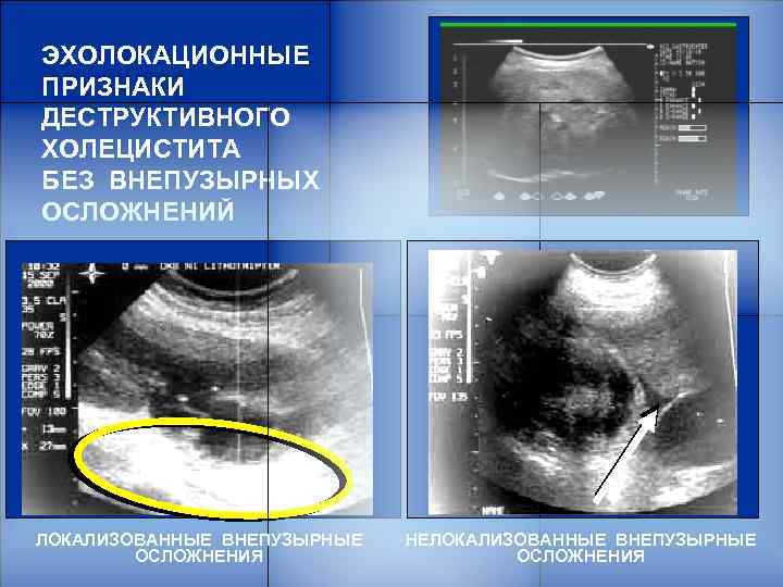 ЭХОЛОКАЦИОННЫЕ ПРИЗНАКИ ДЕСТРУКТИВНОГО ХОЛЕЦИСТИТА БЕЗ ВНЕПУЗЫРНЫХ ОСЛОЖНЕНИЙ ЛОКАЛИЗОВАННЫЕ ВНЕПУЗЫРНЫЕ ОСЛОЖНЕНИЯ НЕЛОКАЛИЗОВАННЫЕ ВНЕПУЗЫРНЫЕ ОСЛОЖНЕНИЯ 