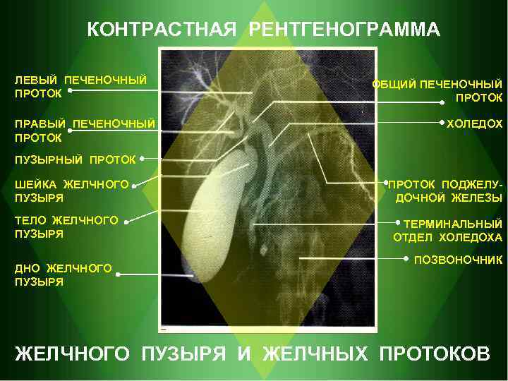 КОНТРАСТНАЯ РЕНТГЕНОГРАММА ЛЕВЫЙ ПЕЧЕНОЧНЫЙ ПРОТОК ПРАВЫЙ ПЕЧЕНОЧНЫЙ ПРОТОК ОБЩИЙ ПЕЧЕНОЧНЫЙ ПРОТОК ХОЛЕДОХ ПУЗЫРНЫЙ ПРОТОК