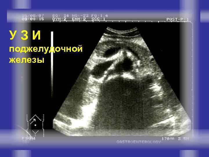 УЗИ поджелудочной железы 