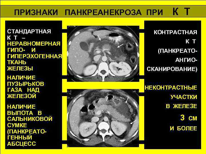 Острый панкреатит презентация хирургия